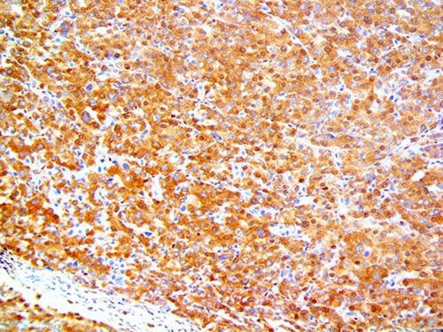 IHC of SMAD4 on a FFPE Pancreatic Cancer Tissue
